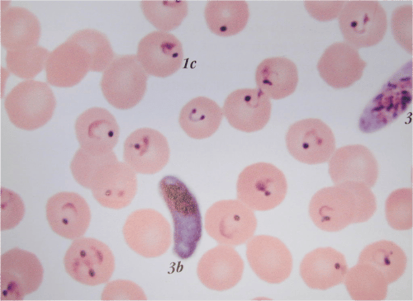 <p>HbS cells with <em>P. falciparum </em>sickle more quickly since the parasite uses the oxygen</p><p>- asplenic= fatal </p>