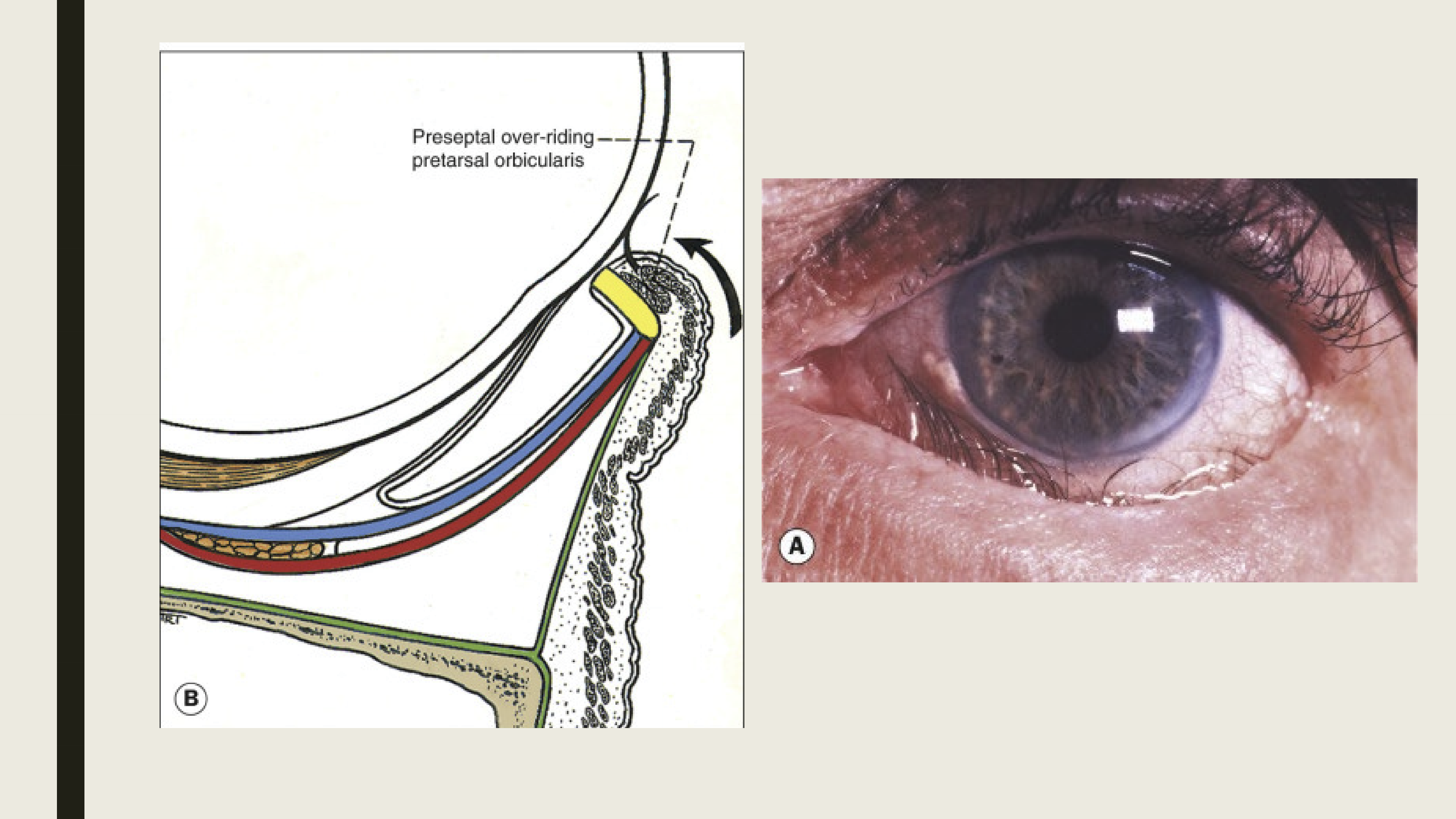 <p>The inward turning of the lower lid margin</p>