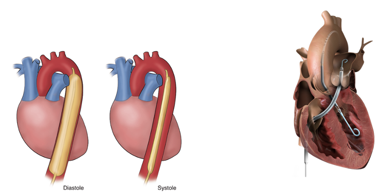 <p>These are temporary, in-hospital measures until definitive treatment can be completed. (bridge treatments)</p><ul><li><p>Both of these interventions are in place for less than 30 days.</p></li><li><p>It buys the patient time until a PCI or CABG can be performed.</p></li></ul><p><strong>Intra-Aortic</strong>: it inflates and blocks the aorta during diastole and then during systole when the heart contracts, it deflates to let the blood pass. (improves injection fraction)</p><p><strong>Impella</strong>: “outdoor motor”—it is fed up into the ventricle and it anchors itself in there. It helps push the blood out with every beat.</p><p></p>