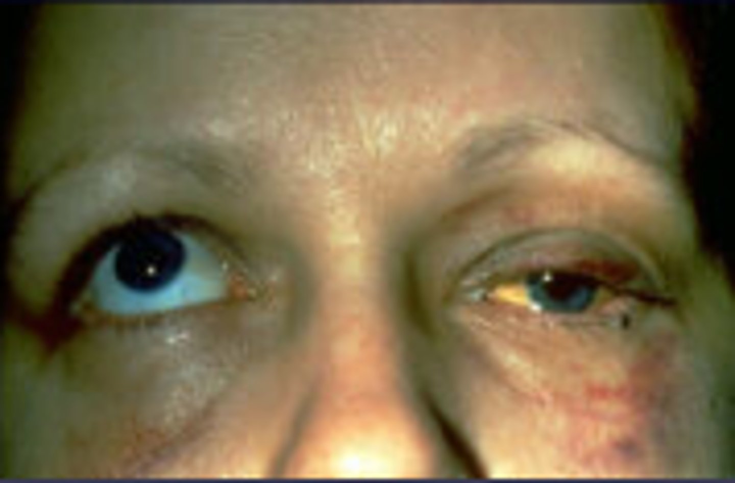 <p>Fracture of the bony orbit of the face, can affect the extraocular muscles of the eye and result in uneven tracking of the eyes</p>