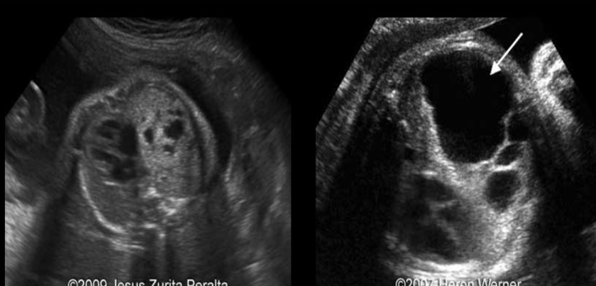 <p>there are several cysts in the left lung that measure <strong>2-4 cm</strong>. this is</p><p>.</p><p>macrocystic = 1</p><p>medium cystic</p><p>microcystic = 3 [&lt;0.5cm]</p><p>.</p><p>a) type 2 congenital cystic adenomatoid malformation</p><p>b) bronchogenic cyst</p><p>c) type 1 congenital cystic adenomatoid malformation</p><p>d) type 3 congenital cystic adenomatoid malformation</p>