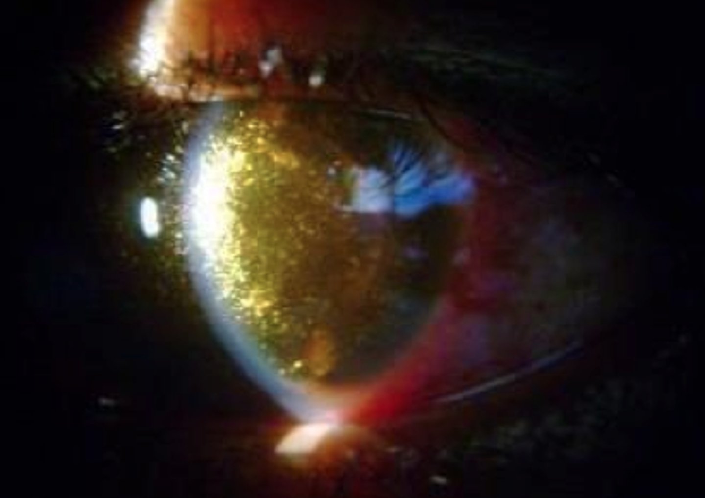 <p>Highly refractile, multicolored crystals that move freely and fall to the floor of the vitreous chamber</p>