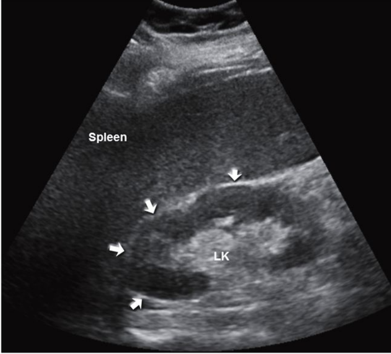 <p>Normal long kidney : arrows pointing to relationship of kidney to spleen </p>