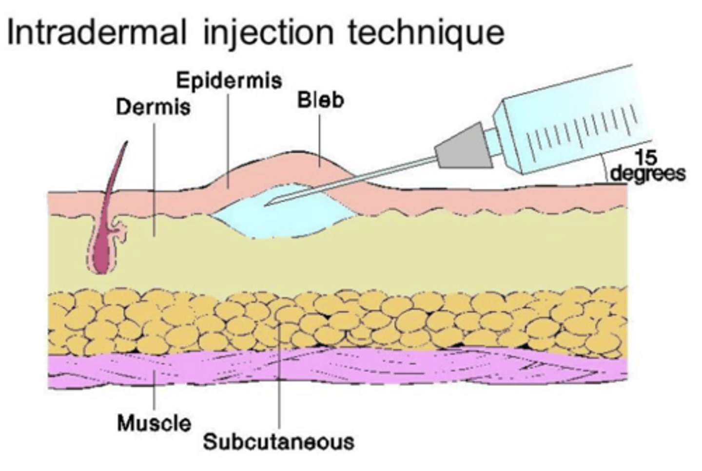 <p>- into the dermis rather than beneath</p><p>- 0.05-0.1 mL</p><p>- allergy test or tuberculin skin test</p>