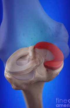 <p>A C-shaped cartilage in the knee that acts as a cushion between the femur and tibia on the inner side, providing stability and shock absorption. </p>