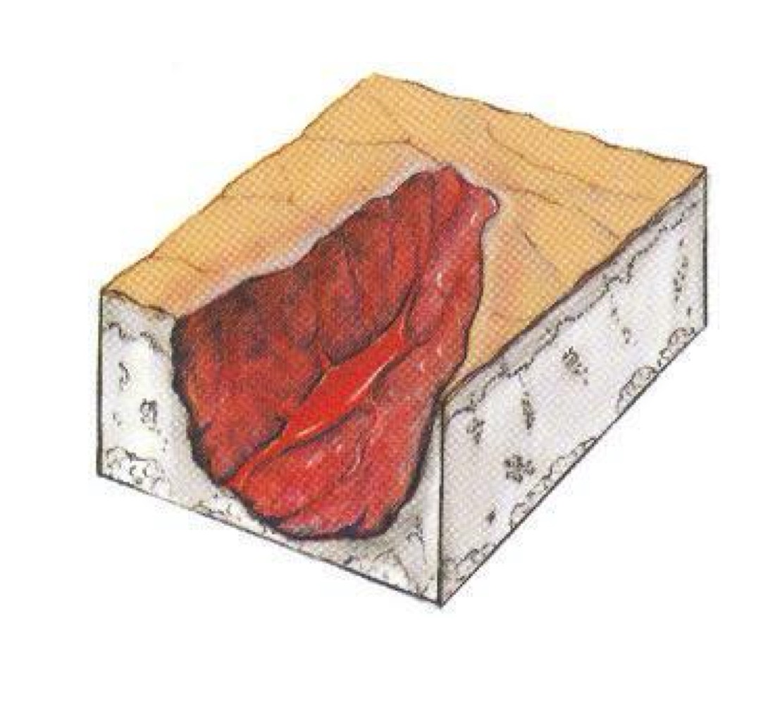 <p>what type of skin lesion is this? </p>