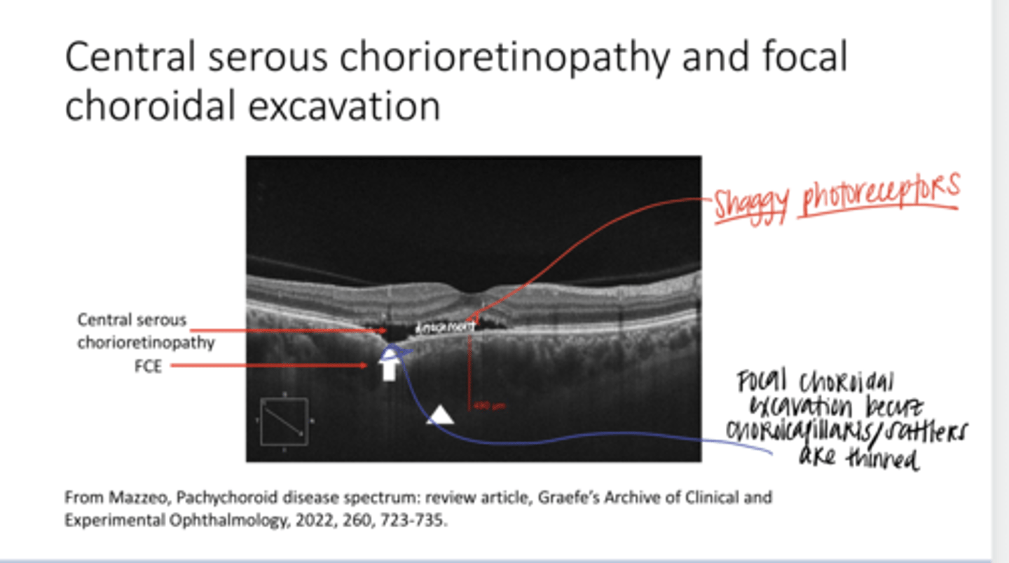<p>Central Serous Chorioretinopathy and Focal Choroidal Excavation (Pic)</p>