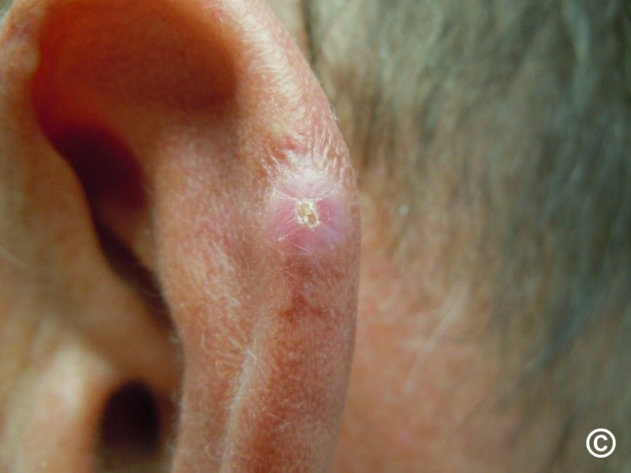 <p>painful+tender papule</p><p>chronic inflammatory lesion</p><p>affects cartilaginous portion of ear</p><p>may turn red</p><p>most common: helix<br>antihelix</p><p>biopsy→rule out carcinoma</p>