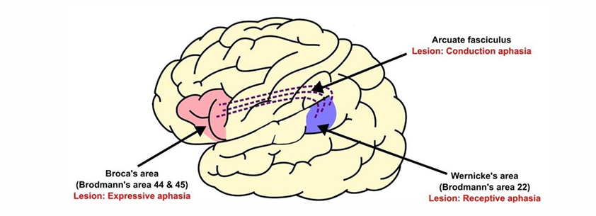 <ul><li><p><strong>Broca’s aphasia</strong> (left inferior frontal gyrus): Non-fluent speech, good comprehension.</p></li><li><p><strong>Wernicke’s aphasia</strong> (left posterior superior temporal gyrus): Fluent but meaningless speech, poor comprehension</p></li><li><p>Conduction lesion- arcuate fasciculus which joins broca’s and wenicke’s </p></li></ul><p></p>