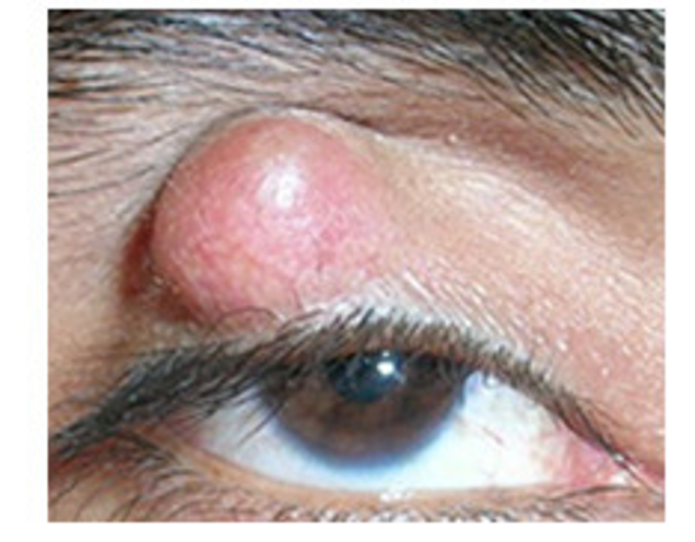 <p>obstruction of meibomian gland; nontender; firm</p>
