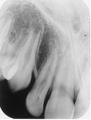 <p>What dental anomaly is seen in this image?</p><p> </p><p>supernumerary tooth</p><p> </p><p>external root resporption</p><p> </p><p>dens in dente</p>