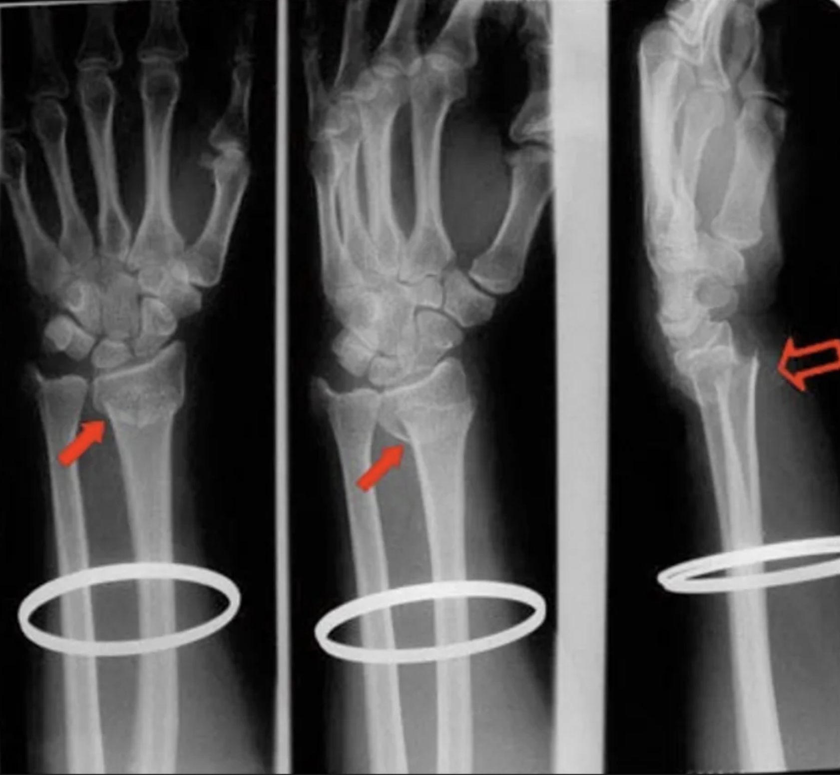 <p>63 year old female:</p><p>acute pain and swelling in her distal forearm after falling on her outstretched hand. </p><p><strong>History: </strong></p><ul><li><p>postmenopausal</p></li><li><p>bone mineral density from forearm indicated osteoporosis</p></li></ul><p><strong>Physical Examination: </strong></p><ul><li><p>deformity of distal forearm </p></li><li><p>posterior displacement of distal radius&nbsp;</p></li><li><p>Acute tenderness and swelling of distal forearm/wrist&nbsp;</p></li><li><p>Paraesthesia over lateral palm /digits &amp; weakness in thumb opposition</p></li></ul><p></p>