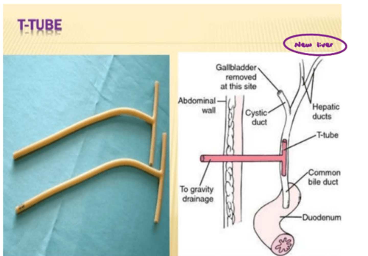 <p>Bile production is ______________________ prognostic indicator because it means that new liver is working! → We have to offload it into bile bag for ~3 months post-op d/t _______________________ and _______________________.</p>