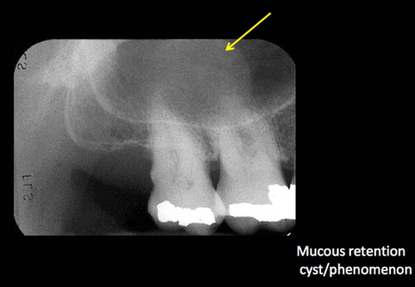 <p>Mucous retention cyst in the maxillary sinus</p>