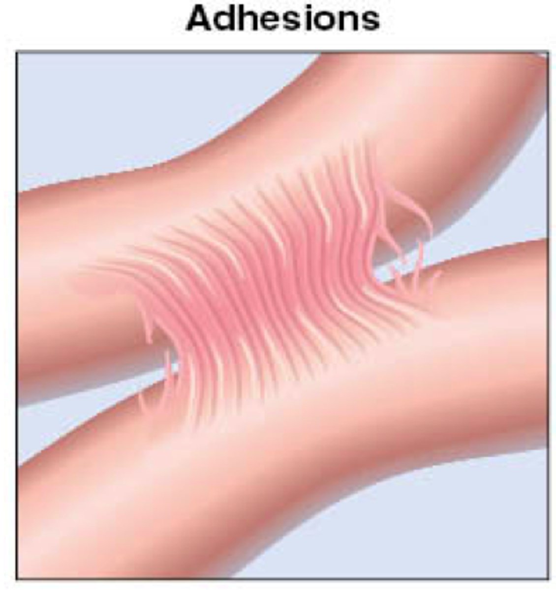 <p>internal scar tissue btw tissues and organs</p>