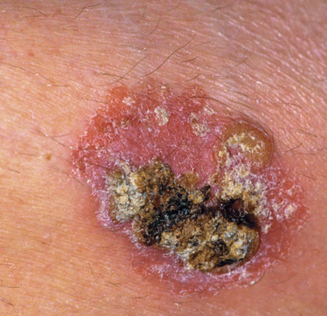 <p>skin cancer that begins in the epidermis but may grow into deeper tissue; does not generally metastasize to other areas of the body</p>