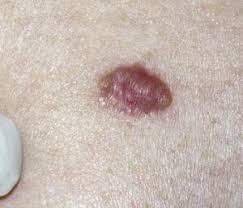 <p><span>A malignant NEOPLASM whose cells appear to be derived from EPITHELIUM. This word can be used by itself or as a suffix. Cancers composed of columnar epithelial cells are often called adenocarcinomas. Those of squamous cells are called squamous cell carcinomas.</span></p>