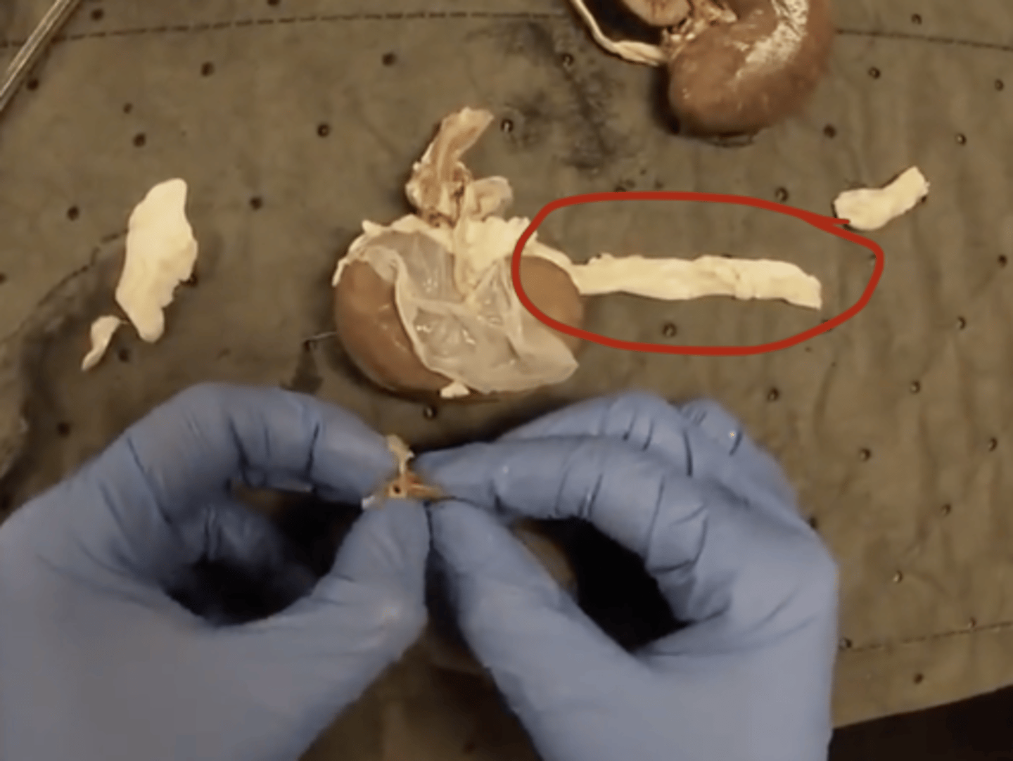 <p>DEFINITION</p><p>Muscular tube transporting urine to the bladder.</p>