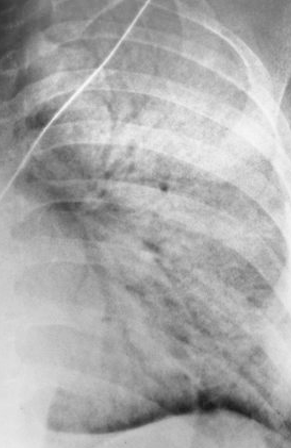<p>this is alveolar pneumonia, what is the RA</p>