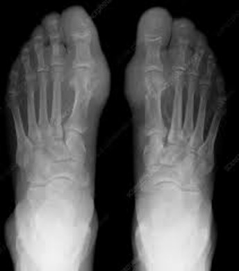 <p>Gout</p>