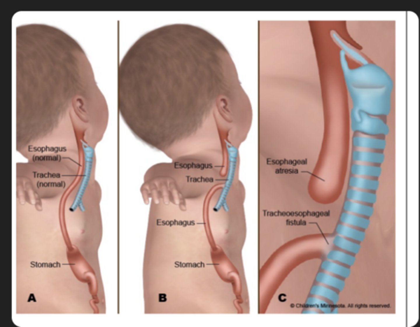 <p>Abnormal partitioning of trachea and esophagus.</p>