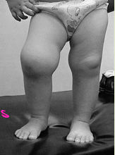 <p><strong>Juvenile Idiopathic Arthritis: General Symptoms</strong></p><p>-Joint _________, pain, stiffness </p><ul><li><p>The joint swelling is often more acute and triggered by some sort of event </p></li></ul><p>-Physical exam may reveal joint ______/effusion, erythema, limited ___, tenderness to palpation</p><p>-__________ is a potential ocular manifestation, as it is associated with other rheumatologic disorders </p><p></p>