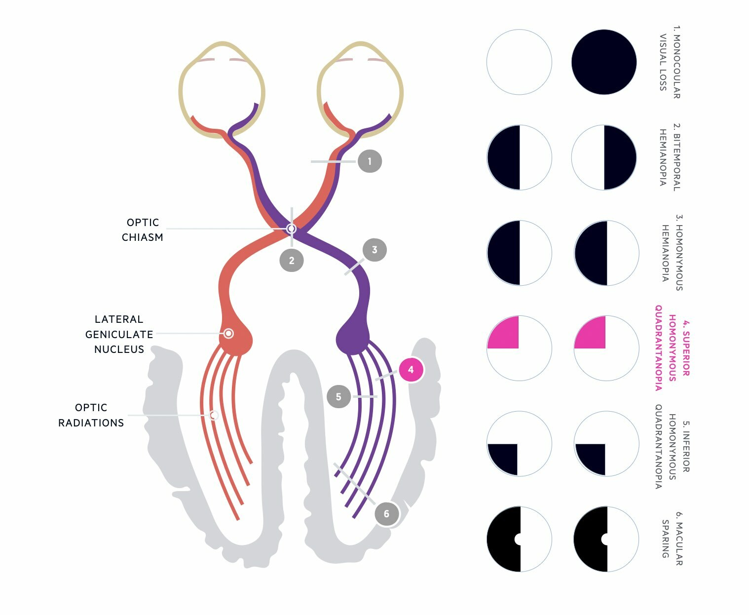 <p><span><strong>Potential Artefacts in Visual Field Testing</strong></span></p><ul><li><p><span>Q: What factors can interfere with visual field test results? A: Lenses, cataracts, pupil irregularities, and poor positioning</span></p></li></ul><p class="MsoNormal"></p>