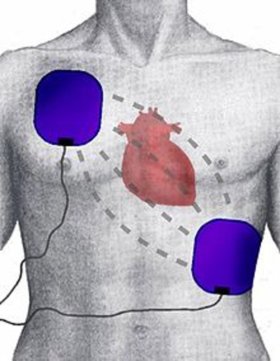<p>shocking the heart back into beating again by delivering an electric current to the heart which will, in turn, return the heart to a regular rhythm</p>