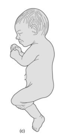 <p>hips are extended and one or both feet are closest to the cervix-requires C section</p>