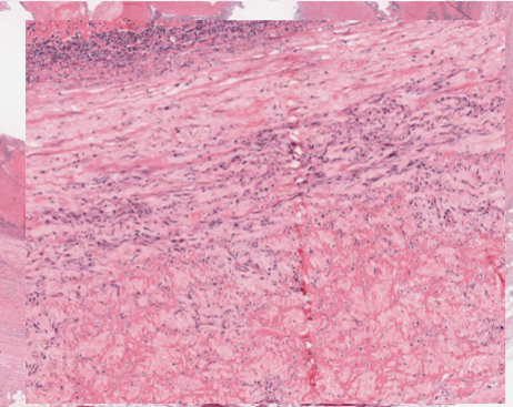 <p>specific form of lytic necrosis, occurs during vascular damage </p><p></p><p>intramural () accumulation of fibrin, other proteins and immunocomplexes in vessels ( associated with vasculitis) </p>