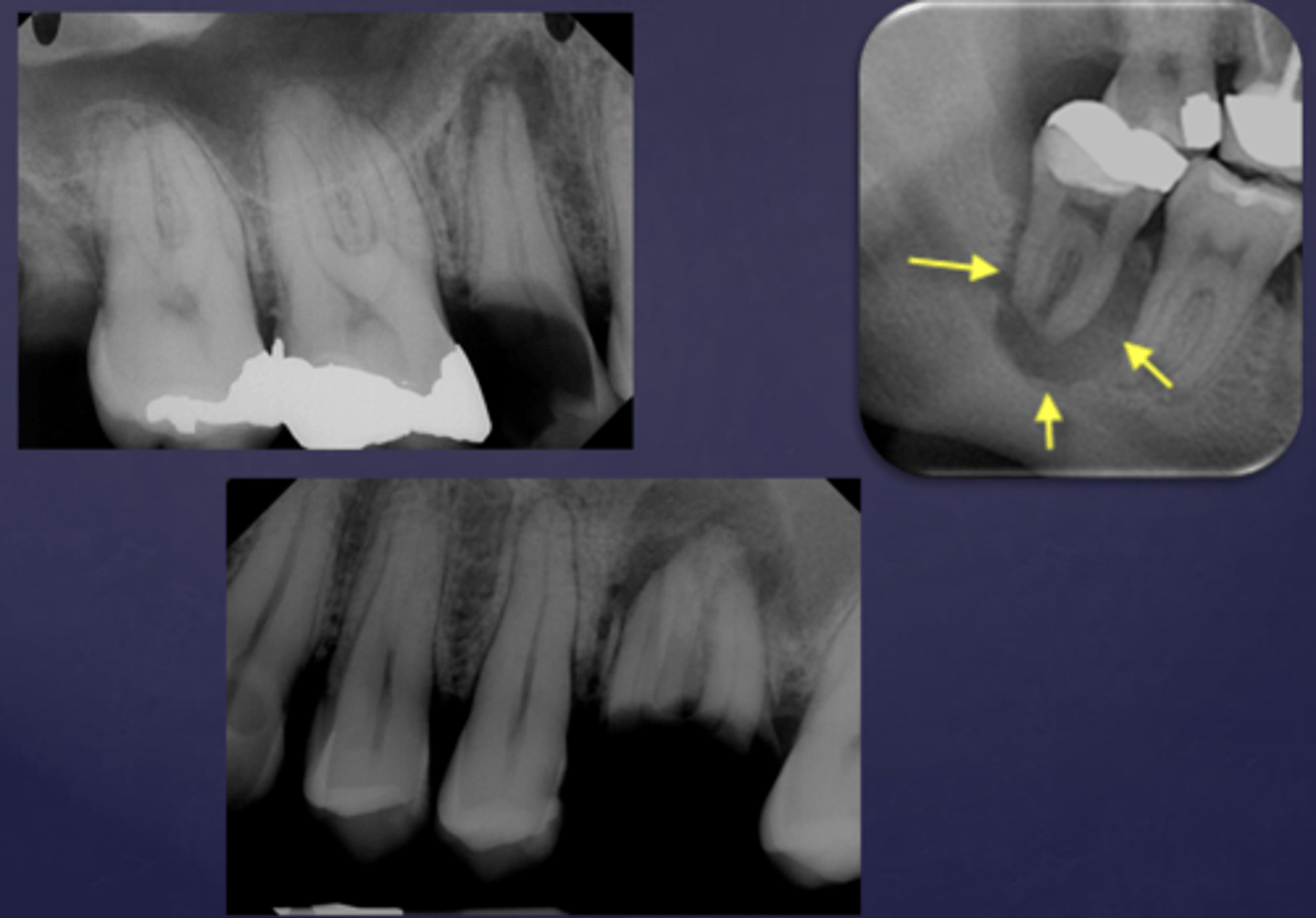 <p>Rarefying osteitis leads to what radiographically?</p>