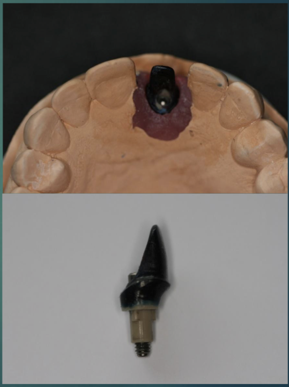 <p>steps of ceramic implant abutment </p>