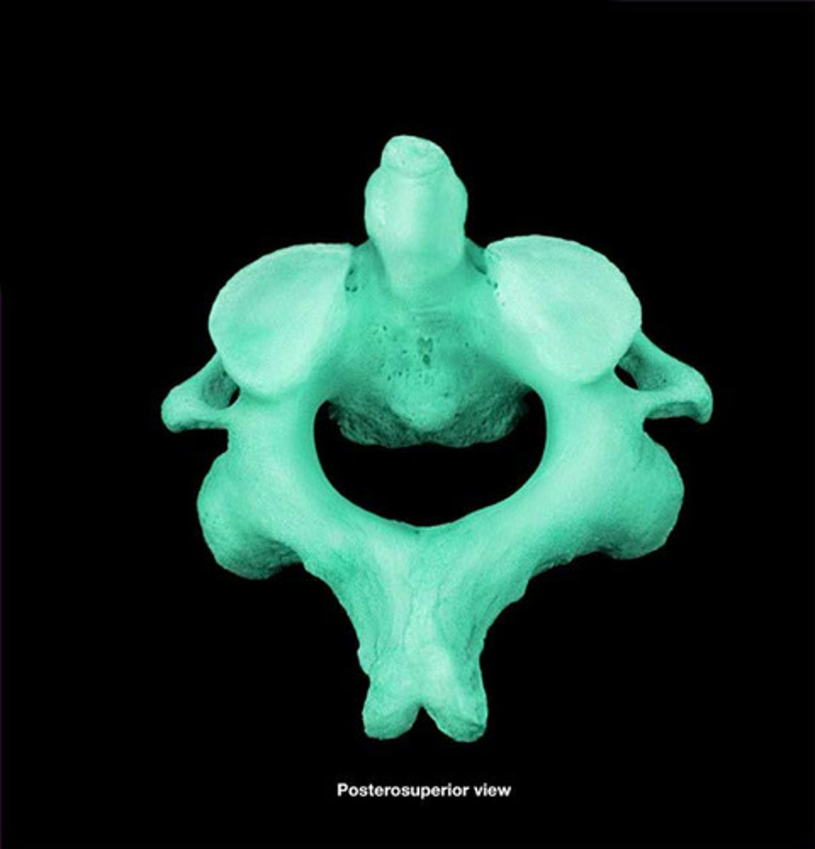 <p>The Second Vertebrae found in the Cervical Vertebrae. The bone that the Atlas rests on. Allows the skull to rotate laterally.</p>