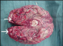<p>Other organs that may become infected include the pericardium, spleen, skin, and brain </p><p></p>