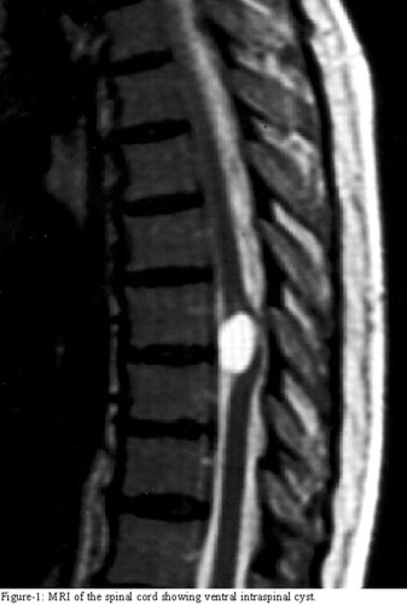 <p>masses of endodermally derived tissue commonly associated with the spinal cord; derived from the neurenteric canal where ectoderm and endoderm are closely associated</p>