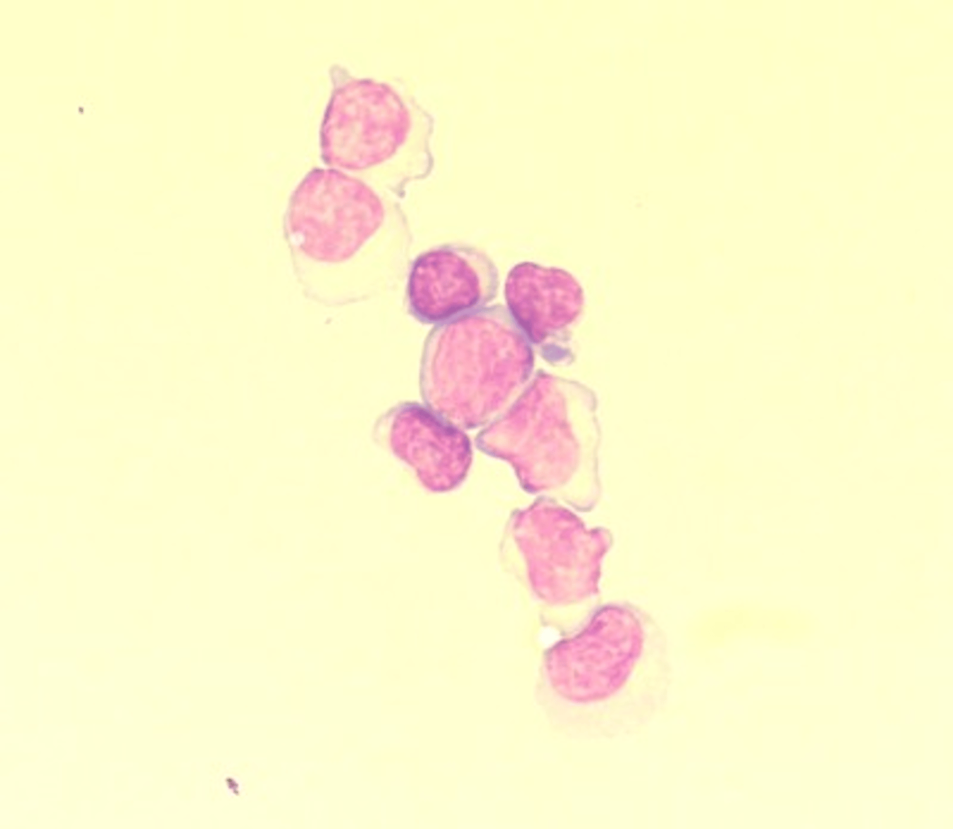 <p>A college student is treated in the hospital for suspected meningitis. Which cells should be identified in the cerebrospinal fluid (CSF) report for the cytospin field that is shown?</p>