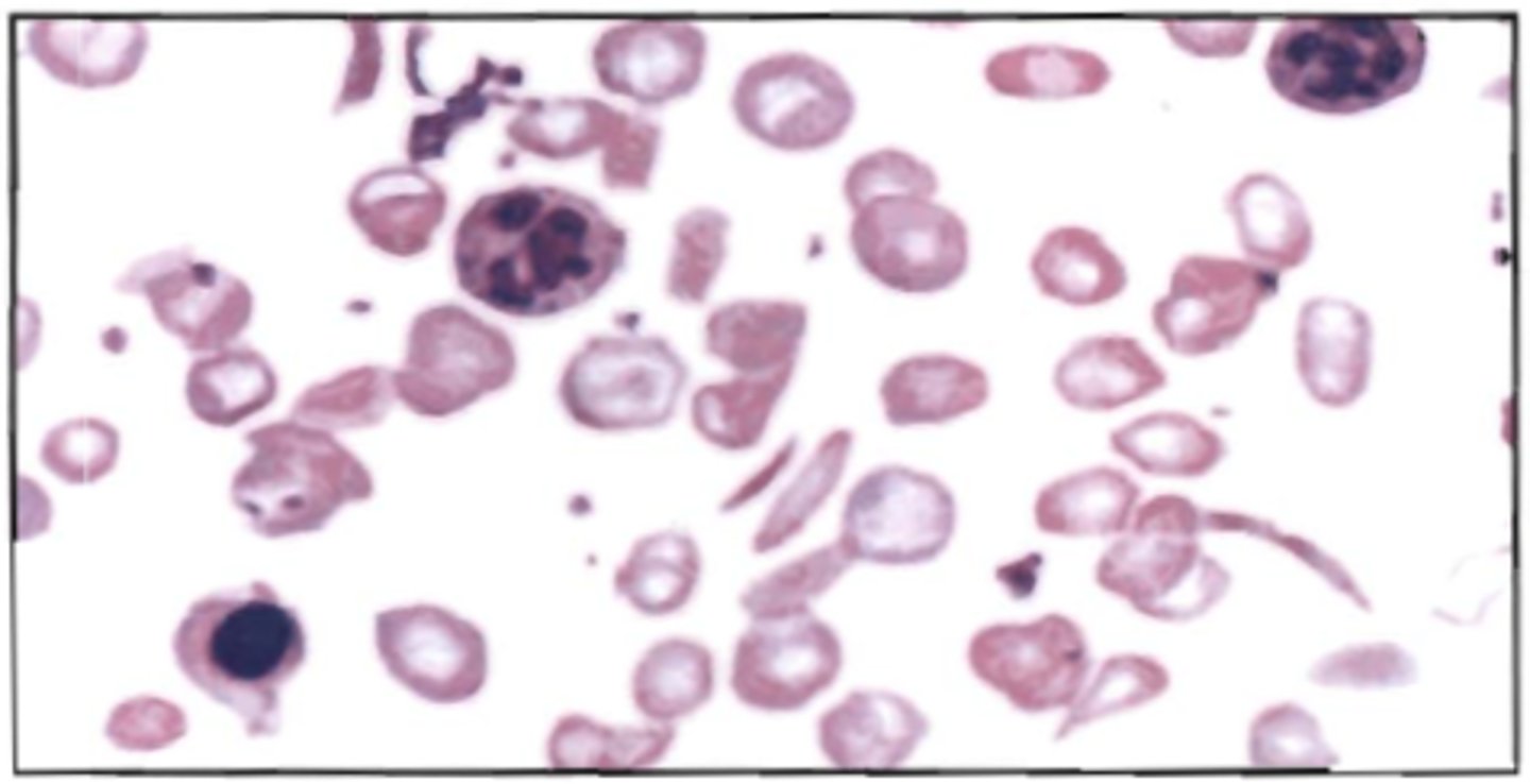 <p>69. Using a supra vital stain, the polychromatic red blood cells below would probably be:</p><p>A. rubricytes (polychromatophilic normoblast)</p><p>B. retibulocytes</p><p>C. sickle cells</p><p>D. target cells</p>
