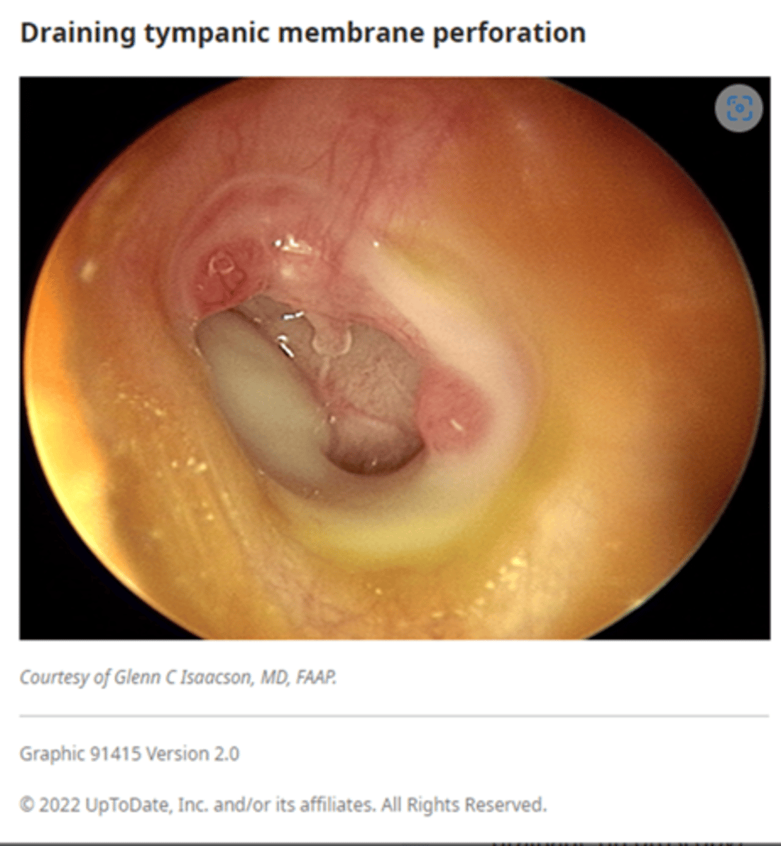 <p>Chronic (&gt; 6 weeks) purulent middle ear discharge (Otorrhea)<br><br>Otorrhea can be persistent or intermittent<br><br>Conductive hearing loss<br><br>Perforated TM with purulent middle ear drainage on otoscopy</p>