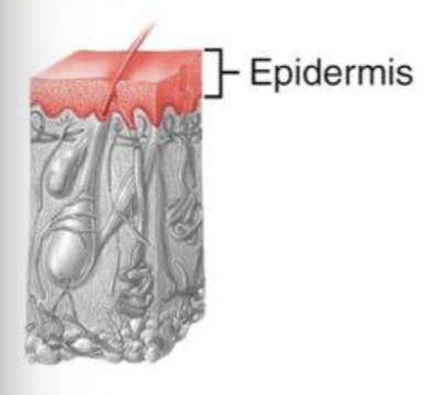 <p>Involves only the epidermis; Ex/ sunburn</p>