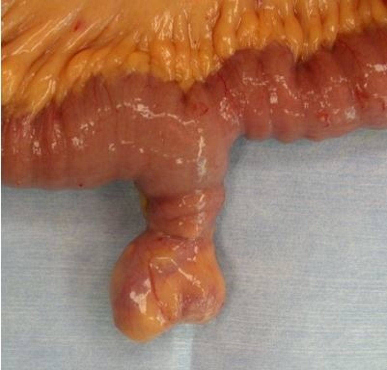 <p>1.) Meckel's scan</p><p>2.) Meckel's diverticulitis</p><p>3.) Surgery</p>