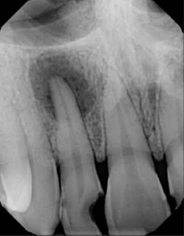 <p>how would you describe this lesion </p>