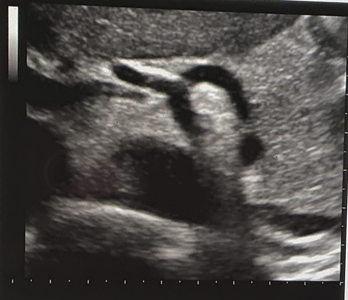 <p>If you are scanning your patient in the transverse plane at the level demonstrated in the image, which way would you slide your transducer to see the SMA?</p>