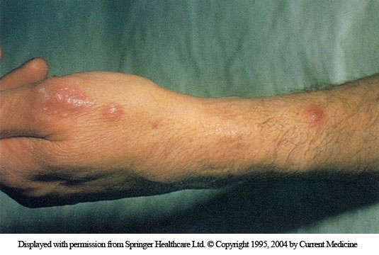 <p>person ulcerating, pusutular nodules , associated lymphatic channels. asymptomatic, after plants (rose bush) </p>
