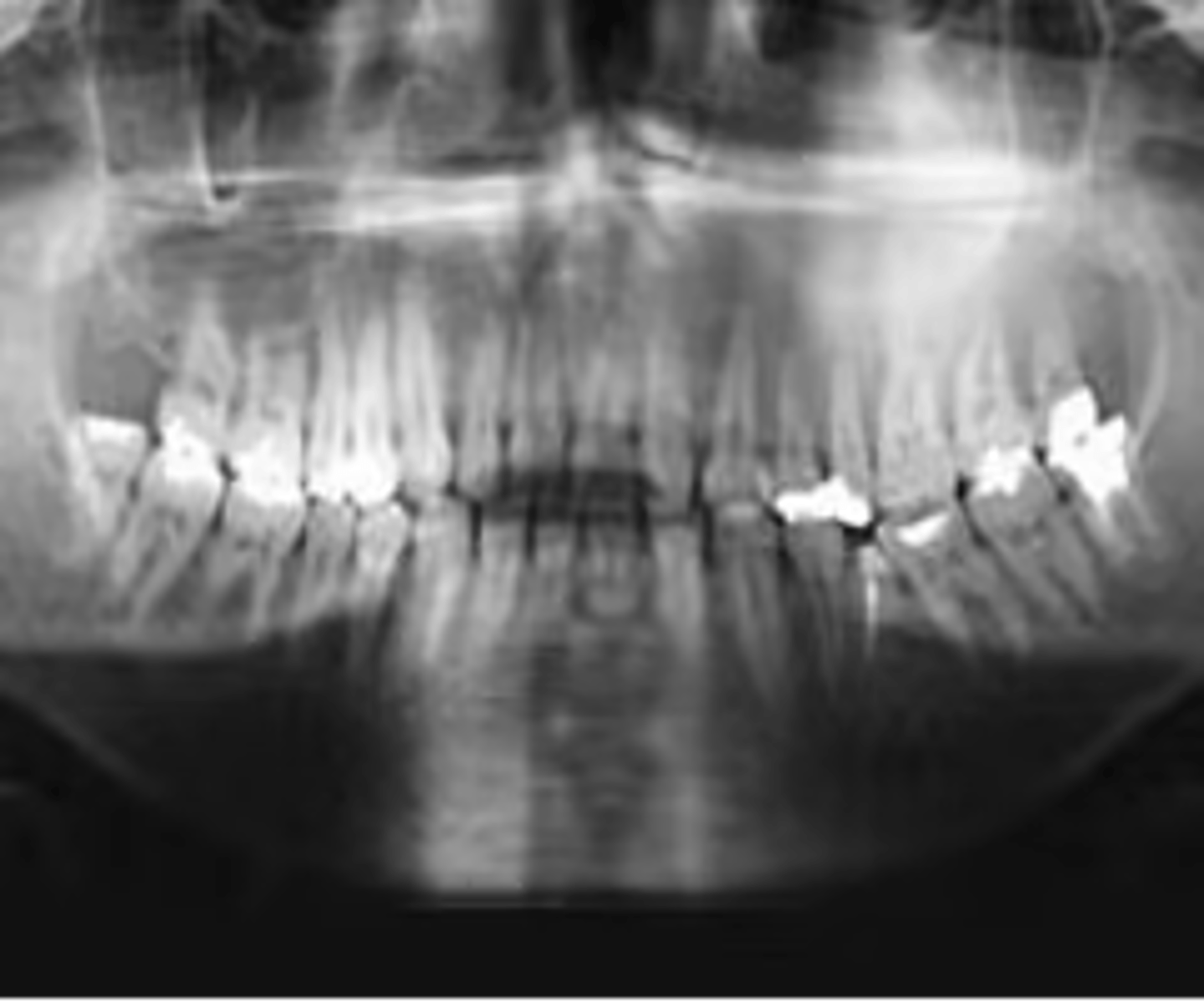 <p>What is the diagnosis?</p><p>16 y/o patient presents with facial asymmetry from swelling. Patient denies pain. Radiograph shows a slow growing diffuse/ ill-defined dense sclerotic pattern that is orange-peel/fingerprint/ground glass/cotton wool-like in appearance in the posterior maxilla. There is expansion of the maxilla, tooth displacement and loss of lamina dura of adjacent roots. Opacification of the maxillary sinus is also noted.</p>