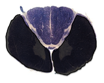 <p>a lesion here would cause…?</p>