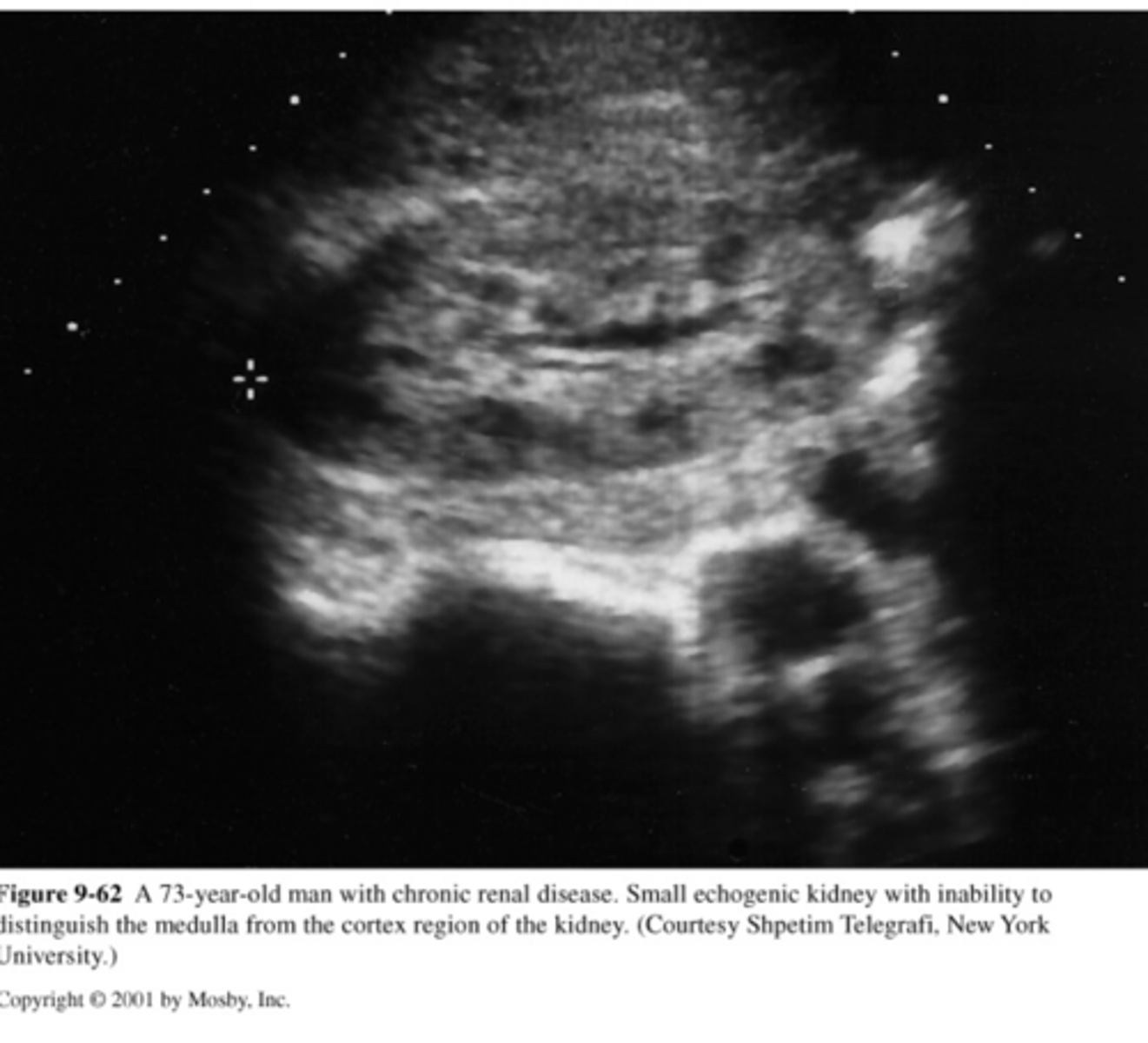 <p>-small kidneys with smooth borders</p><p>-scarring</p><p>-lobar infarction</p>
