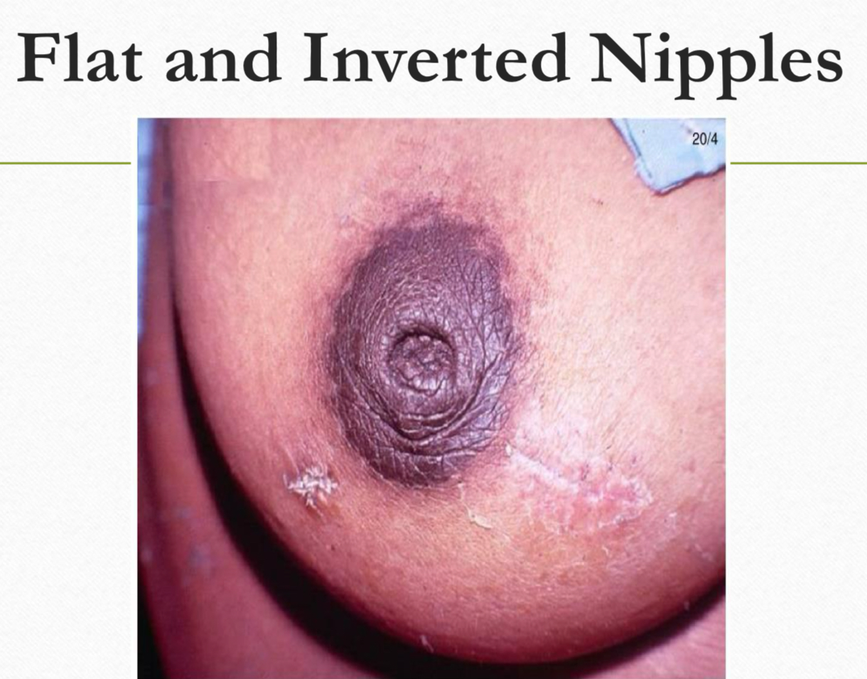 <p>What are the management for flat and inverted nipples ?</p>