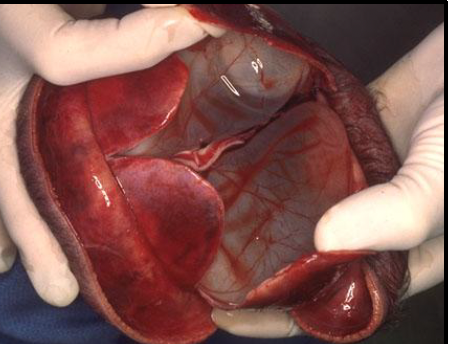 <p>cerebral hemispheres are absent; brain is filled with CSF within sacs</p>