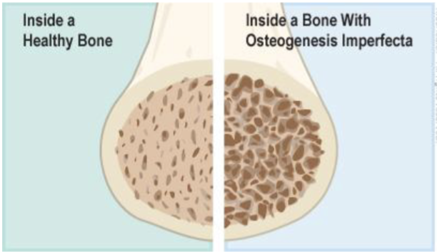 <p><span style="color: blue">Osteogenesis imperfecta (OI) is a disease associated with a mutation in COL1A1, a gene than synthesizes collagen. Scientists studying _______ of this disease, found that 70% of mice that carry the mutated gene exhibited symptoms of OI<br>A. Penetrance<br>B. Expressivity<br>C. Epistatic interaction<br>D. Incomplete dominance</span></p>