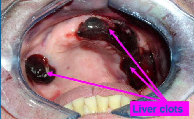 Oozing continues underneath- need to be removed
